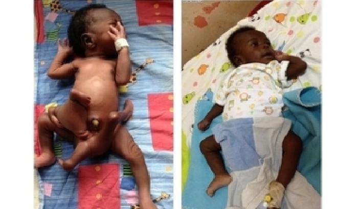 00F430-NEWS_126839 Bimbo nasce con 4 gambe e 4 braccia: operato