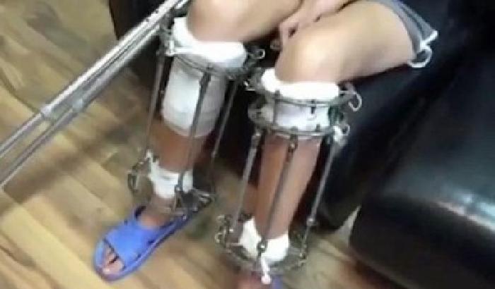 010D67-NEWS_139646 Vuole fare la modella: si opera per crescere 6 centimetri