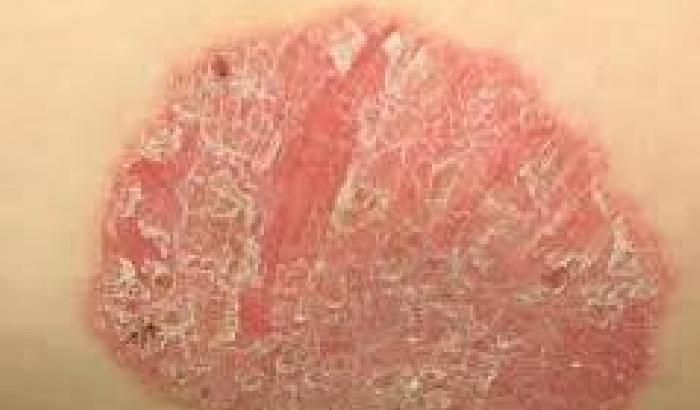 0114B3-NEWS_143455 2,5 milioni di italiani soffrono di Psoriasi