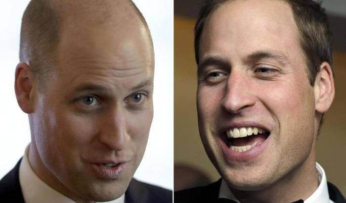 Anche il principe William è finito "vittima" della calvizia