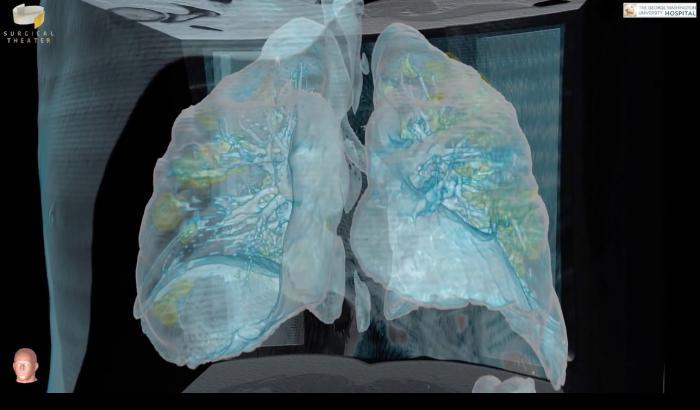 Qual è l'effetto del Covid sui polmoni? La risposta in uno studio tra Londra e Trieste