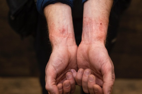 Maciej Moskwas-wounds.-Picture-by-Maciej-Nabrdalik La denuncia: "Noi giornalisti ammanettati dai militari polacchi per aver fatto foto al confine"