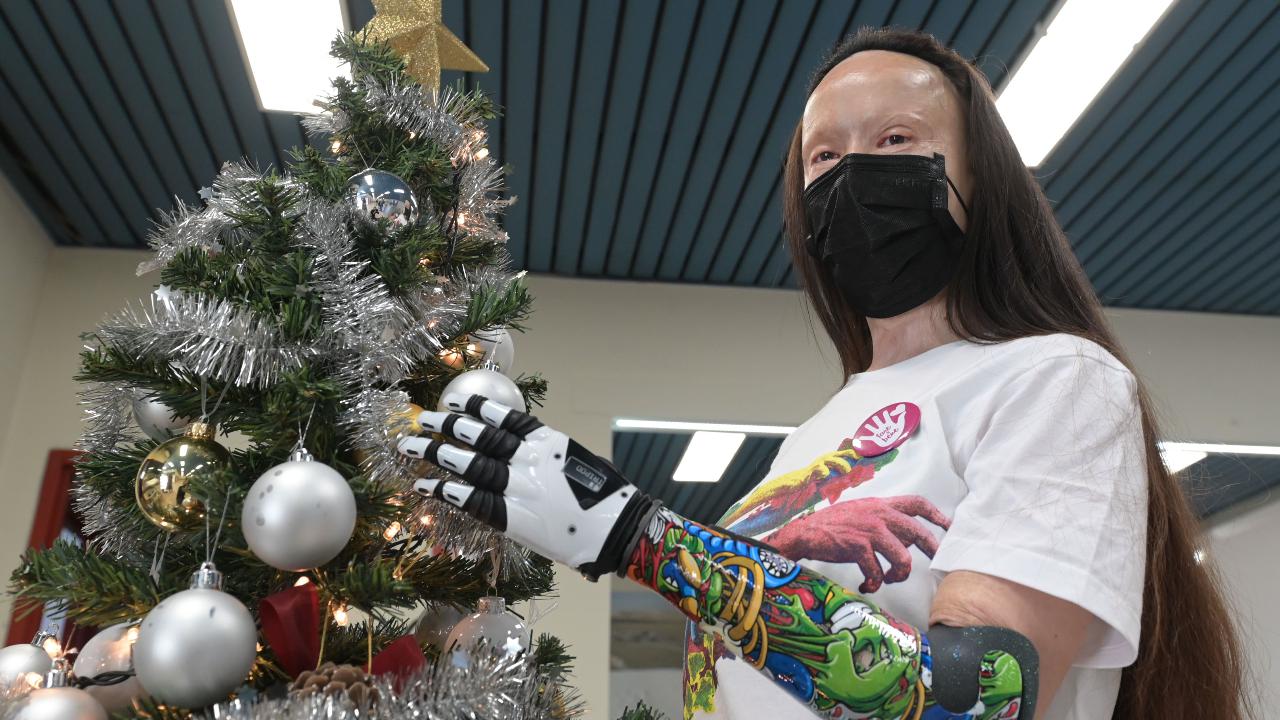 Fu sfigurata e seviziata dal marito: una mano bionica per Valentina Pitzalis, la donna che sopravvisse al femminicidio