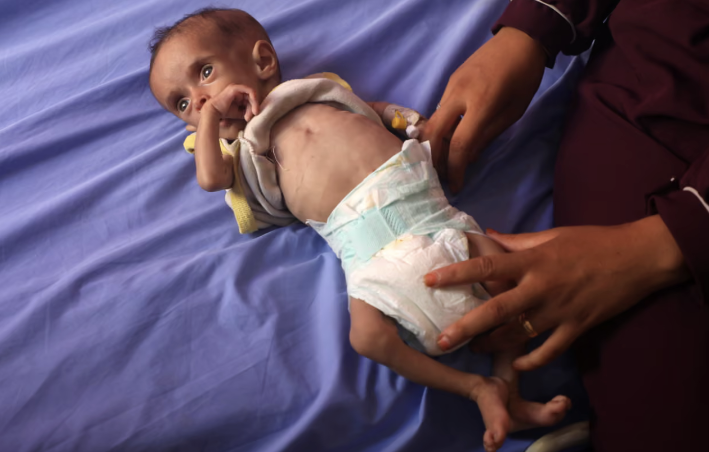 Screenshot 2025-07-25 alle 17.15.35 Gaza sta esaurendo gli alimenti terapeutici per salvare i bambini malnutriti: allarme delle agenzie Onu